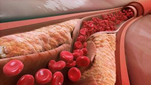 Mokslininkai atrado novatorišką aukšto cholesterolio gydymo būdą