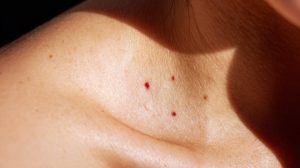Pastebėjote raudonus taškelius ant odos? Dermatologas atsako, ką jie gali reikšti