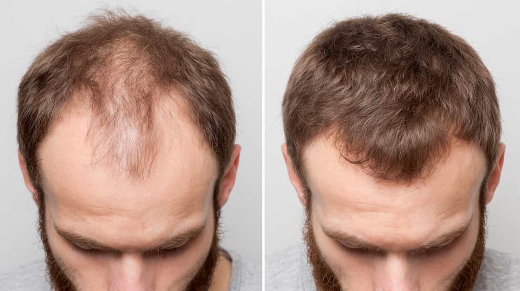 Plaukų slinkimui galas? Rastas būdas atauginti plaukus per 20 dienų