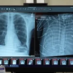 Dirbtinis organas 48 valandas palaikė žmogų be plaučių – gyvybė išsaugota iki transplantacijos