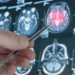 Nauji duomenys: šis kasdienis produktas gali sumažinti Alzheimerio riziką net ketvirtadaliu