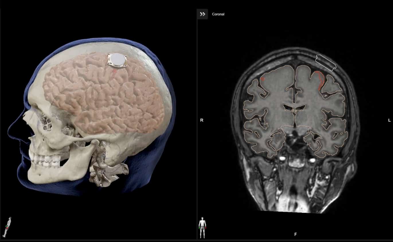 Pirmasis žmogui įdiegtas „Neuralink“ smegenų implantas patyrė gedimą